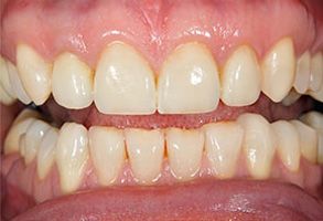 The image shows a close-up view of a person s teeth with visible staining, particularly at the front.