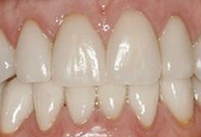 The image shows a close-up view of a person s teeth with a focus on their lower front teeth, which appear to be discolored or stained, possibly due to tobacco use.