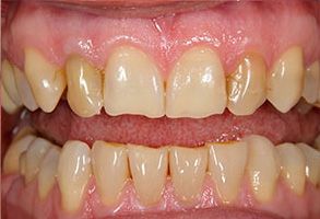 The image displays a close-up of a person s teeth with a focus on the lower front teeth, showcasing a dental procedure such as teeth whitening or cosmetic dentistry.