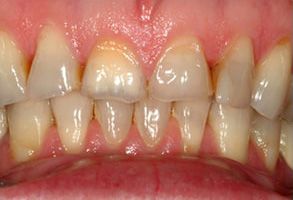 The image shows a close-up view of a person s teeth with visible yellowing and staining, suggesting poor oral hygiene or the need for dental care.
